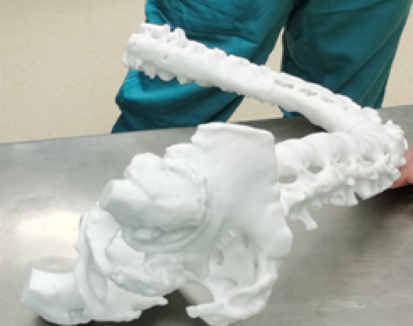 3D打印技术辅助高难度全髋关节置换术 手术效果非常满意